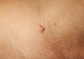 Hati-Hati Kutil pada Penis Jadi Salah Satu Ciri Pasangan Terkena Virus HPV, Penyebab Kanker Payudara, dan Serviks