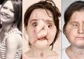 Jalani Operasi Hingga 31 Jam, Katie Jadi Orang Termuda yang Terima Transplantasi Wajah
