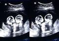 Video Bayi Kembar Identik 'Mo-Mo' Ini Terlihat Berantem di Rahim Ibunya Saat di USG
