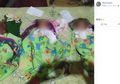 Ibu Asal Sulawesi Tengah Meninggal Saat Melahirkan Bayi Kembar 3: Ini Risiko Hamil dan Melahirkan Bayi Kembar