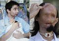 2,5 Tahun Rasakan Hidup Tanpa Wajah, Pria Ini Akhirnya Dapatkan Mata dan Hidung Baru Usai Transplantasi