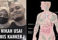Sepasang Kekasih Batal Menikah Setelah Keduanya Divonis Kanker: Ini Gejala Kanker Getah Bening yang Sering Tidak Disadari
