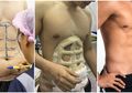 Tren Operasi Plastik Baru; Sekarang Pria Tak Perlu Repot Olahraga Agar Punya Tubuh Six Pack, Tinggal Terbang ke Thailand Saja!