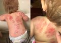 Ditemukan Lebih dari 25 Bekas Gigitan di Punggung Bayi Ini Setelah Ibunya Mengambilnya dari Tempat Penitipan Anak