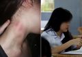 Seorang Ibu Dibuat Kaget Bukan Kepalang Lihat 'Cupang' di Leher Anaknya, Apa Yang Dilakukan Anaknya Sungguh Mengagetkan