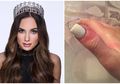 Terlalu Sering Terpapar Sinar UV Saat Perawatan Kuku, Mantan Miss Illinois Ini Terkena Kanker Kulit