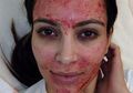 Jalani Facial Vampir, Dua Orang Tertular Virus HIV
