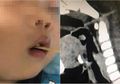 Makan Sosis Bakar, Balita Ini Tertusuk Tusuk Bambu Penusuk Sosis, Tembus Hingga Ke Otak