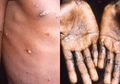 Fakta: Monkeypox alias Cacar Monyet Jauh Lebih Ringan dari Cacar Air