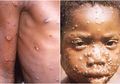 Mengenal Cacar Monyet alias Monkeypox yang Nyatanya Jauh Lebih Ringan dari Cacar Air