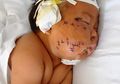 Duh Teganya, Bayi 8 Bulan Ini Ditusuk dengan Gunting 90 Kali Hanya Gara-gara Gigit Puting Ibunya Saat Menyusu
