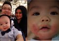 Viral Kisah Bayi Lucu Sakit Kulit Kronis Akibat Dipegang Banyak Orang, ASI Ternyata Bisa Mencegahnya!
