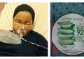 Nekat Pakai Skincare Aloe Vera Palsu, Wajah Cewek Ini Melepuh Parah!