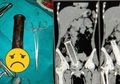 Mengeluh Sakit Perut Selama Dua Tahun, Dokter Malah Keluarkan Stang Motor dari Rahim Wanita Ini, Kok Bisa?
