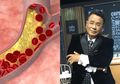 Hotman Paris Hutapea Pernah Didiagnosa Penyempitan Pembuluh Darah: Ini Gejala, Faktor Risiko dan Pencegahannya