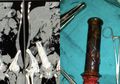 Suami Paksa Handle Motor Masuk ke Tubuh Istri Selama 2 Tahun: Ini 7 Benda Mengerikan yang Pernah Bersarang di Tubuh Manusia