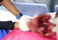 Ngeri, Bocah 13 Tahun Ini Kehilangan Kelima Jarinya Gara-Gara Main Petasan, Peringatan Bagi Bapak-Ibu di Rumah