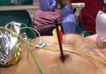 Dengan Panah Tertancap di Dada Pria Ini Bisa Hidup Kembali Setelah Dokter Melakukan Operasi