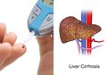 Ingat! Penderita Diabetes Tipe 2 Berisiko Mengalami Sirosis dan Kanker Hati