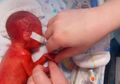 Terlahir Prematur dengan Otak Terlihat dari Kulitnya, Bayi Ini Mengejutkan Banyak Orang di Ulang Tahun Pertamanya