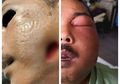 Ingin Obati Sakit Gigi dengan Minyak Rem, Pipi Pria Ini Jadi Bolong