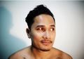 Stress dan Kebanyakan Main HP, Pembuluh Darah Mata Tanta Ginting Pecah, Kenali Bahayanya!