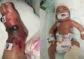 'Salah Tusuk' Saat Transfusi Darah, Kaki Seorang Bayi Jadi Bengkak, Doketr dan Perawat Saling Menyalahkan