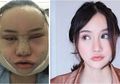 Demi Tampil Cantik Sempurna, Wanita Ini Rela Menahan Rasa Sakit Hingga Pendarahan Selama 4 Bulan Usai Operasi Plastik