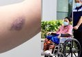 Ani Yudhoyono Tak Sadarkan Diri: Ini 5 Gejala Leukemia yang Sering Kali Diabaikan, Salah Satunya Memar di Tubuh