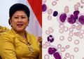 Ani Yudhoyono Meninggal Dunia: Ternyata Sel Leukemia Bisa 'Diatur' Agar Hancurkan Dirinya Sendiri, Ini Caranya!