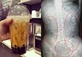 Ratusan Butir Bubble Tea Bersarang Ditubuh Remaja Asal China, Ternyata Ini Dampak Buruk Keseringan Mengonsumsinya