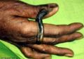 Muncul Tanduk Sepanjang 6 cm pada Ibu Jari Wanita Ini, Kondisi Apakah Ini?