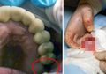 Hilang dari Rahang, Ternyata Gigi Geraham Seorang Bocah 13 Tahun Tumbuh di Dalam Alat Vitalnya