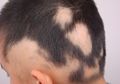 Menyisir Rambut Anak dan Temukan Kebotakan? Kenali Kelainan Alopesia Areata