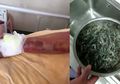 Tertusuk Udang Saat Sedang Mencucinya, Tangan Pria Ini Berakhir Mengerikan, Bahkan Nyaris Mati!