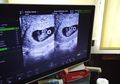 Ahli Kandungan Ini Jelaskan Faktor yang Berpengaruh untuk Dapatkan Bayi Kembar Seperti Syahnaz Sadiqah