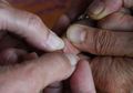 Mudah Sekali, Begini Cara Keluarkan 'Tlusupan' Serpihan Kayu dari Kulit Pakai Bahan Murah Meriah