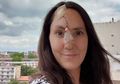 Terkena Kanker Kulit, Hidung Perempuan Ini Bolong karena Tak Pernah Pakai Tabir Surya