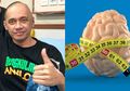 Agung Hercules Idap Kanker Otak: Ukuran Otak Bisa Memprediksi Risiko Kanker Otak, Ini Penjelasannya!