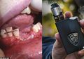 Rokok Elektronik yang Digunakan Remaja Ini Meledak pada Mulutnya hingga Membuat Gigi Rontok dan Rahang Rusak