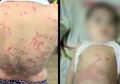 Bayi Ini Tertular Alergi Kulit Lewat ASI Karena Produk Pemutih Palsu yang Dipakai Ibunya, Peringatan Bagi Orangtua!