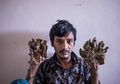 'Manusia Pohon' Ini Tak Kuat Menahan Sakit dan Ingin Diamputasi: Apa Penyebab Sindrom Manusia Pohon?