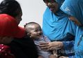 Layanan Operasi Bibir Sumbing Pada Anak Terpaksa Ditunda di Masa Pandemi Covid-19