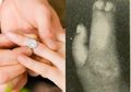 Viral Kakak-Adik Kandung Asal Bulukumba Menikah, Ini Mutasi Genetik yang Bisa Membuat Anak Hasil Inses Menjadi Cacat