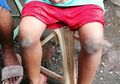 Tinggalkan Tas di Sekolah, Bocah 8 Tahun Dihukum Ibunya Berlutut di Atas Bara Api hingga Kakinya Melepuh