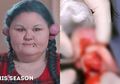 Lakukan Tindik di Bagian Tak Biasa, Telinga Wanita Ini Ditumbuhi Benjolan Daging Seberat Hampir Setengah Kilogram