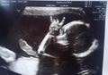 Orangtua Kaget Bukan Main saat Hasil USG Menunjukkan Bayi Melakukan Simbol Metal