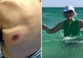 Kurang dari 48 Jam Setelah Berenang di Pantai, Pria Ini Terinfeksi Bakteri Pemakan Daging dan Meninggal