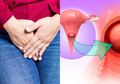 Jadi Kanker Keempat paling Sering Dialami Wanita, Ini Gejala Kanker Serviks yang Harus Diwaspadai