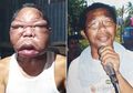 Wajahnya Membengkak Jadi 'Raksasa', Pria Ini Alami Penyakit Mistrius, Begini Gejalanya